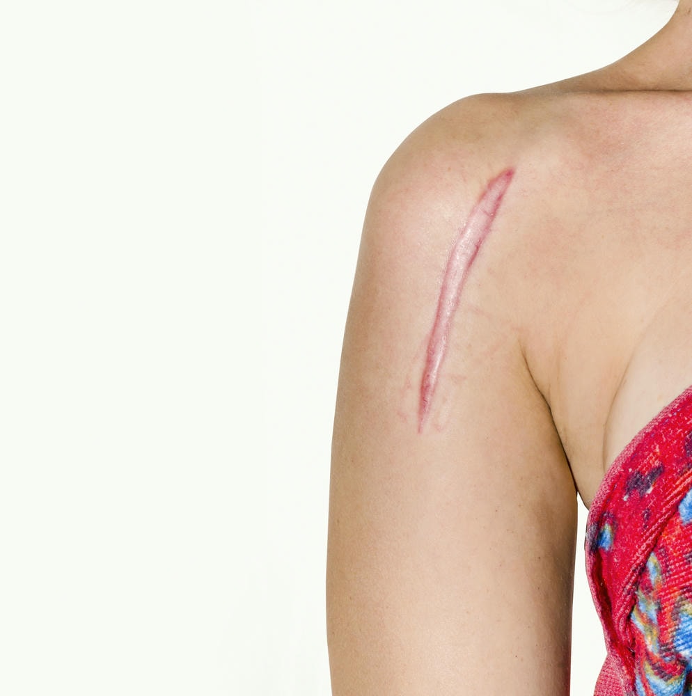 xóa sẹo lồi. Phần giữa của người phụ nữ bị thương ở vai trên nền trắng