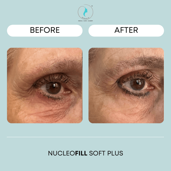 2. Nucleofill và Rejuran khác nhau thế nào?