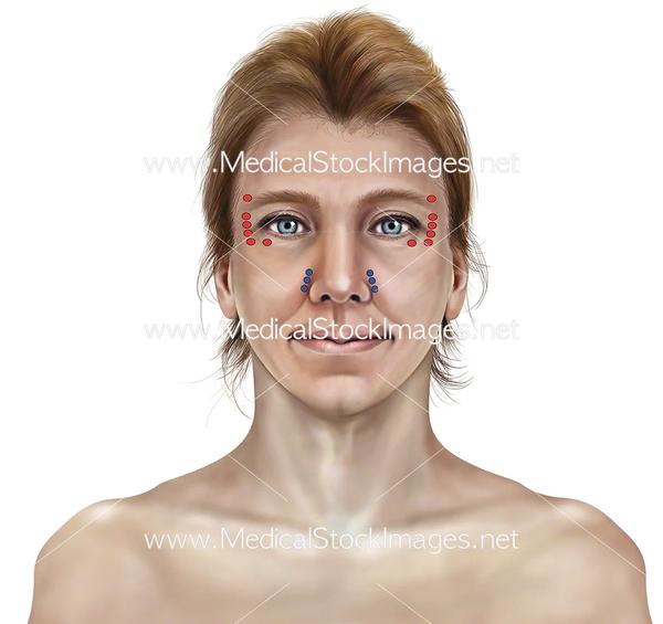 Quy trình cơ bản của injection technique botox