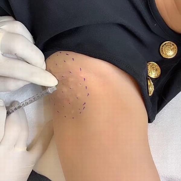 Chi phí và yếu tố ảnh hưởng