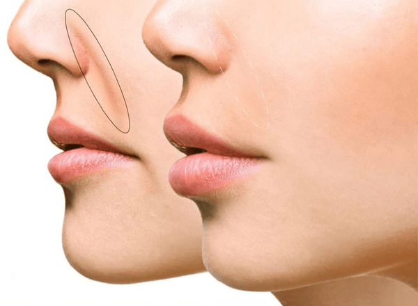 Khi nào chọn tiêm trực tiếp vào rãnh và khi nào chọn làm đầy vùng nâng đỡ