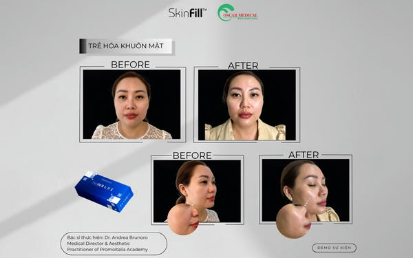 Sự khác biệt giữa filler hàn quốc vs ý và ý nghĩa với người dùng