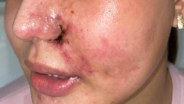 Nguyên nhân gây nốt sần filler