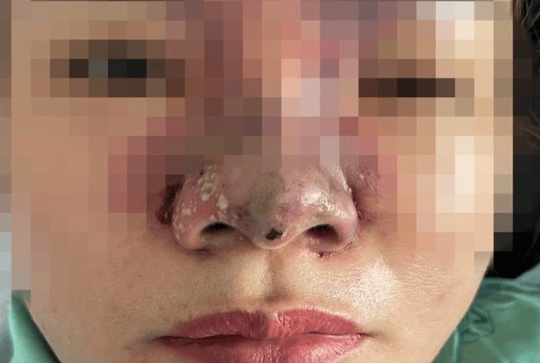 Bảng so sánh nhanh: Nốt sần không viêm vs Nốt sần viêm