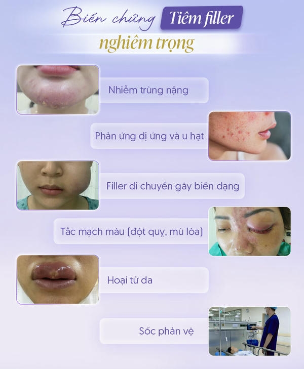Làm sao để giảm nguy cơ: nguyên tắc filler an toàn