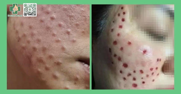 Xử trí khi giảm sắc tố xảy ra