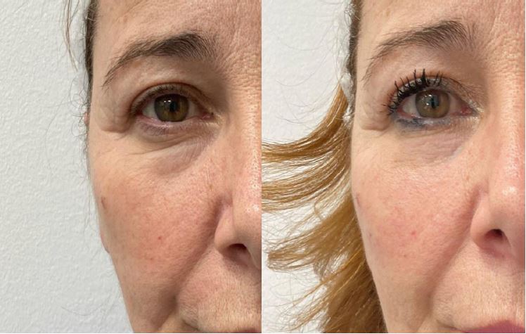 Lợi ích cho skin quality khi chọn PN hoặc HA