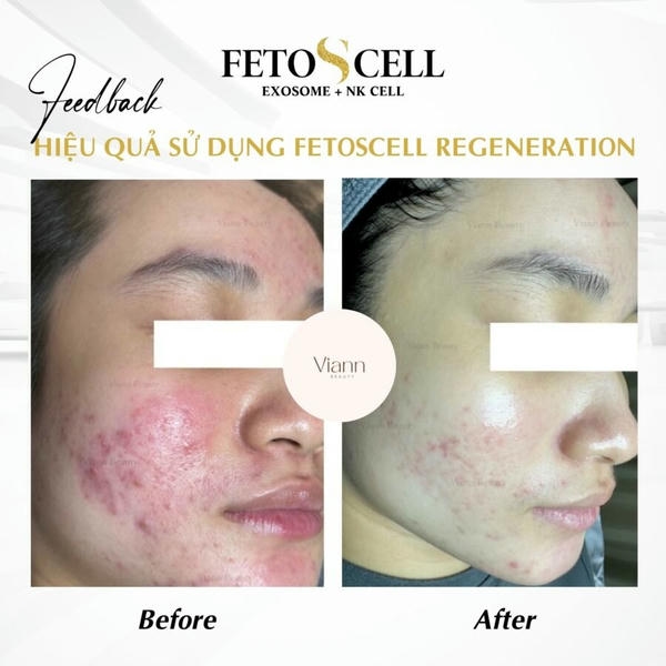 Liệu có thể kết hợp jalupro vs fetoscell trong 1 liệu trình