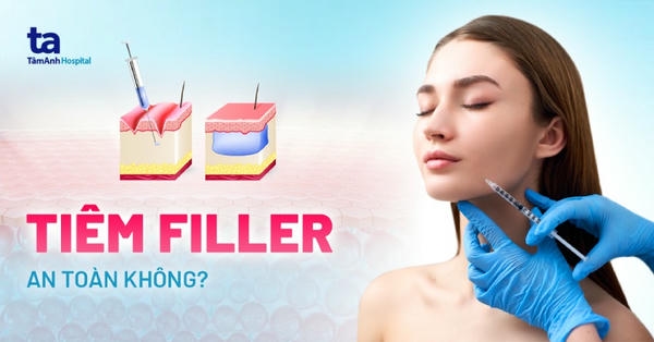 chỉ định filler: khi nào và vùng nào phù hợp