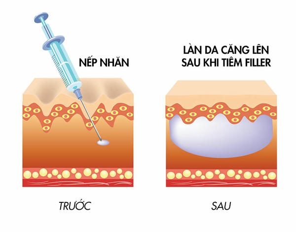 teoxane filler có khác biệt gì