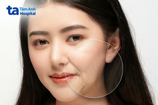 Bảng so sánh ngắn: filler vs perioral botox vs phối hợp
