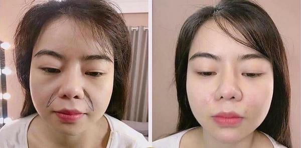 3. Có thể dùng filler rãnh cười cho nasolabial folds sâu không
