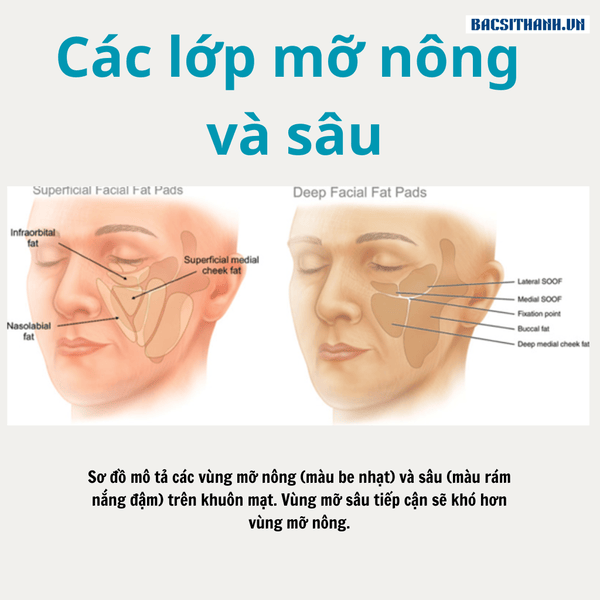 Rãnh mũi má (nasolabial folds): chọn filler để làm mượt nếp gấp