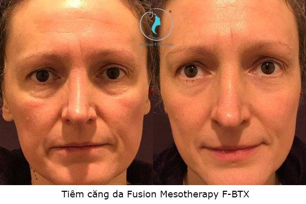 Lộ trình điều trị mẫu cho fusion trẻ hóa