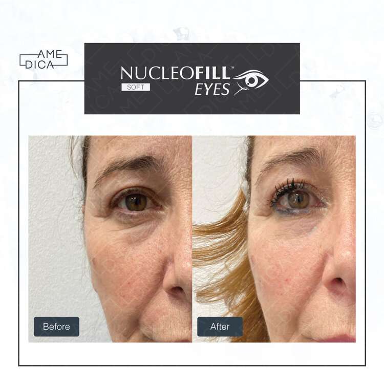 Phân tích chi tiết: ưu nhược của fusion pn và PN