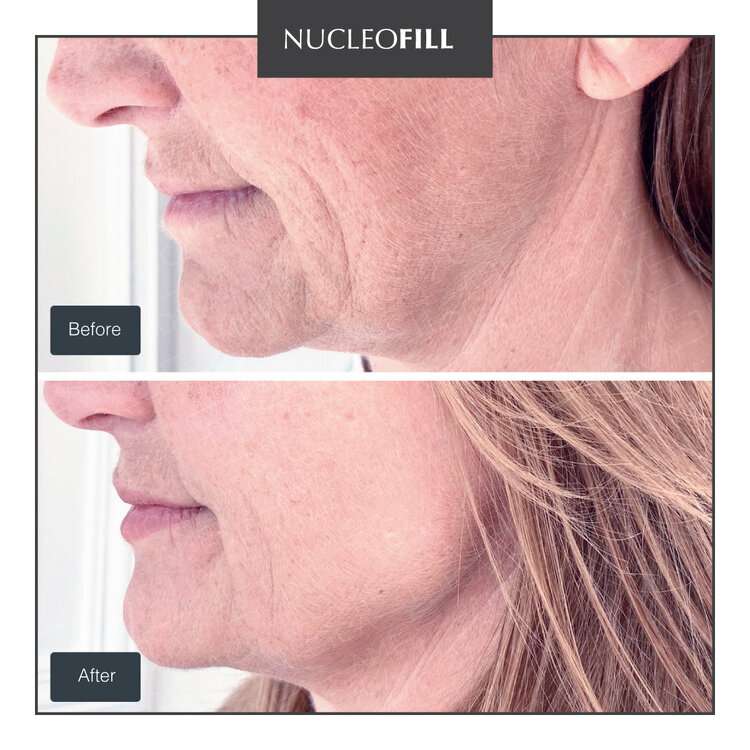 Khi nào nên chọn fusion vs nucleofill hoặc fusion vs pn