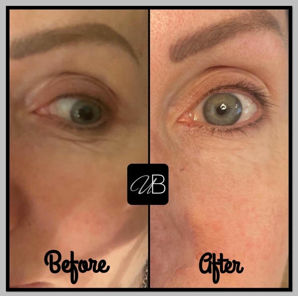 2. Nucleofill khác Rejuran điểm nào