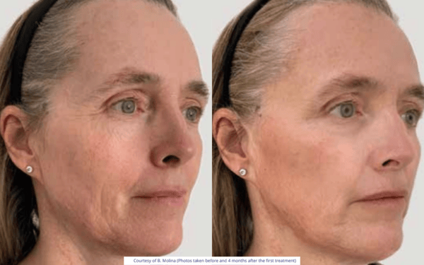 Skinbooster vs mesotherapy: liệu có thể kết hợp được không