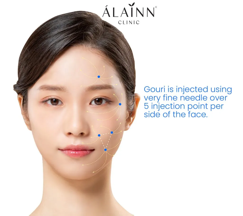 Gouri injection technique: Góc, lớp mô, liều lượng