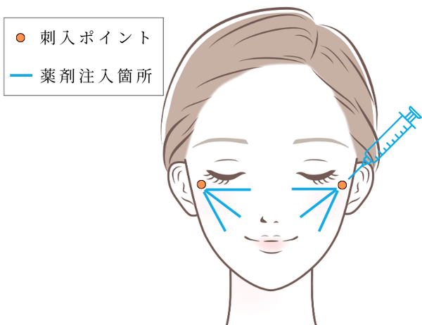 So sánh ngắn: Gouri và filler HA