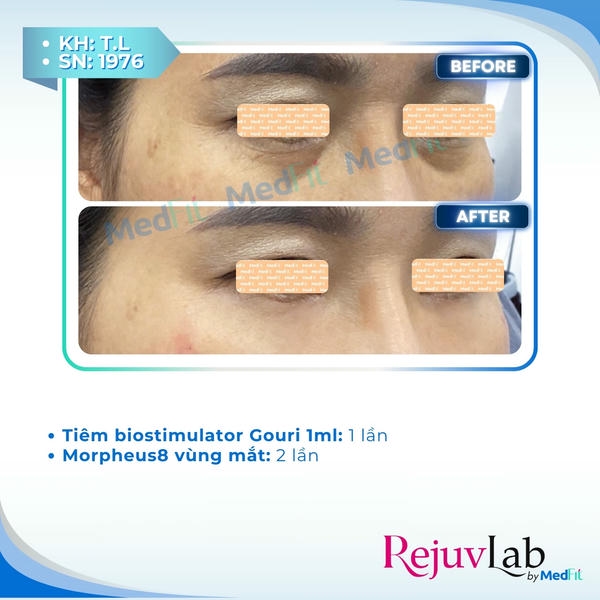 Gouri under eyes cần bao lâu để thấy hiệu quả
