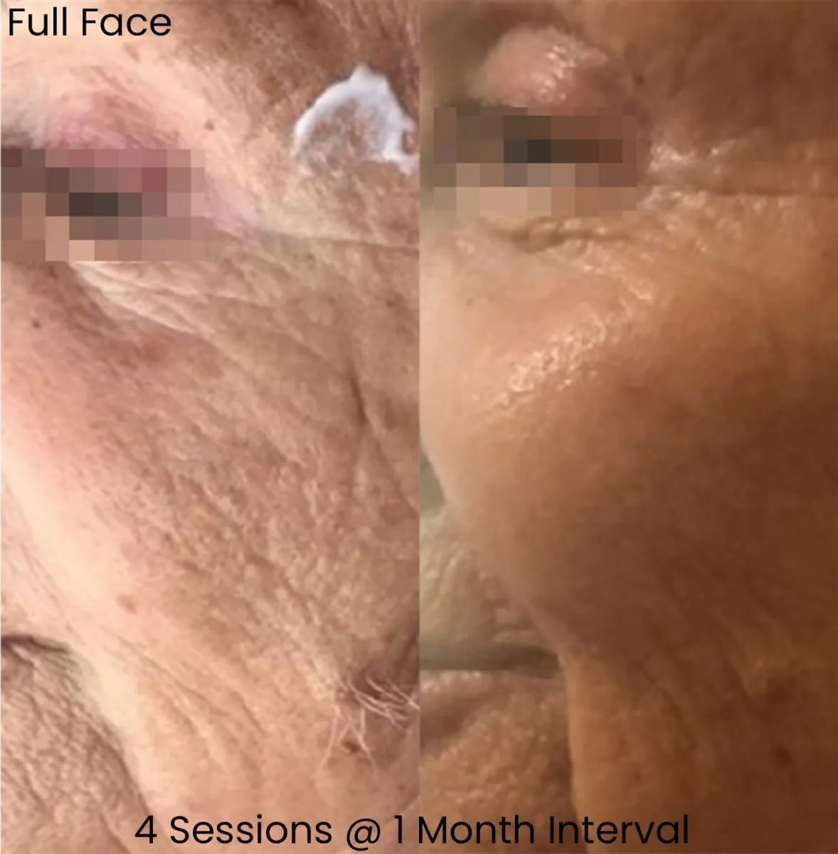 Giới thiệu ngắn về gouri vs profhilo