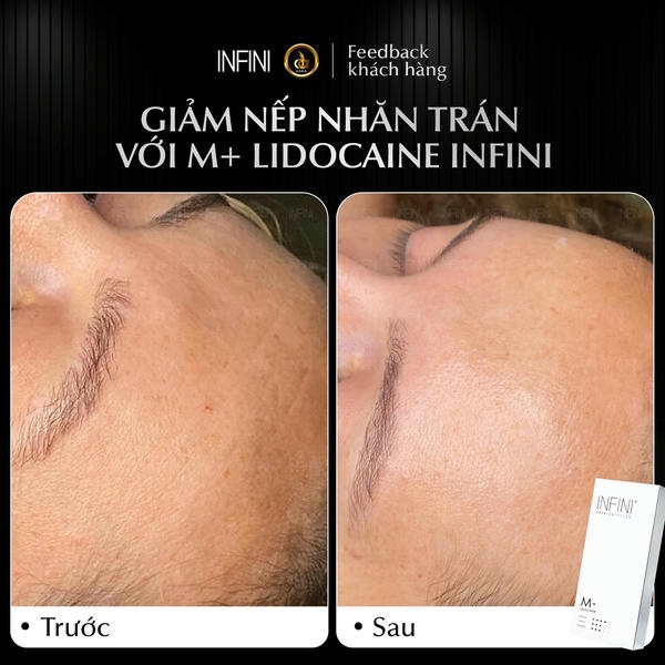 So sánh ngắn giữa trẻ hóa bằng infini và phương pháp khác