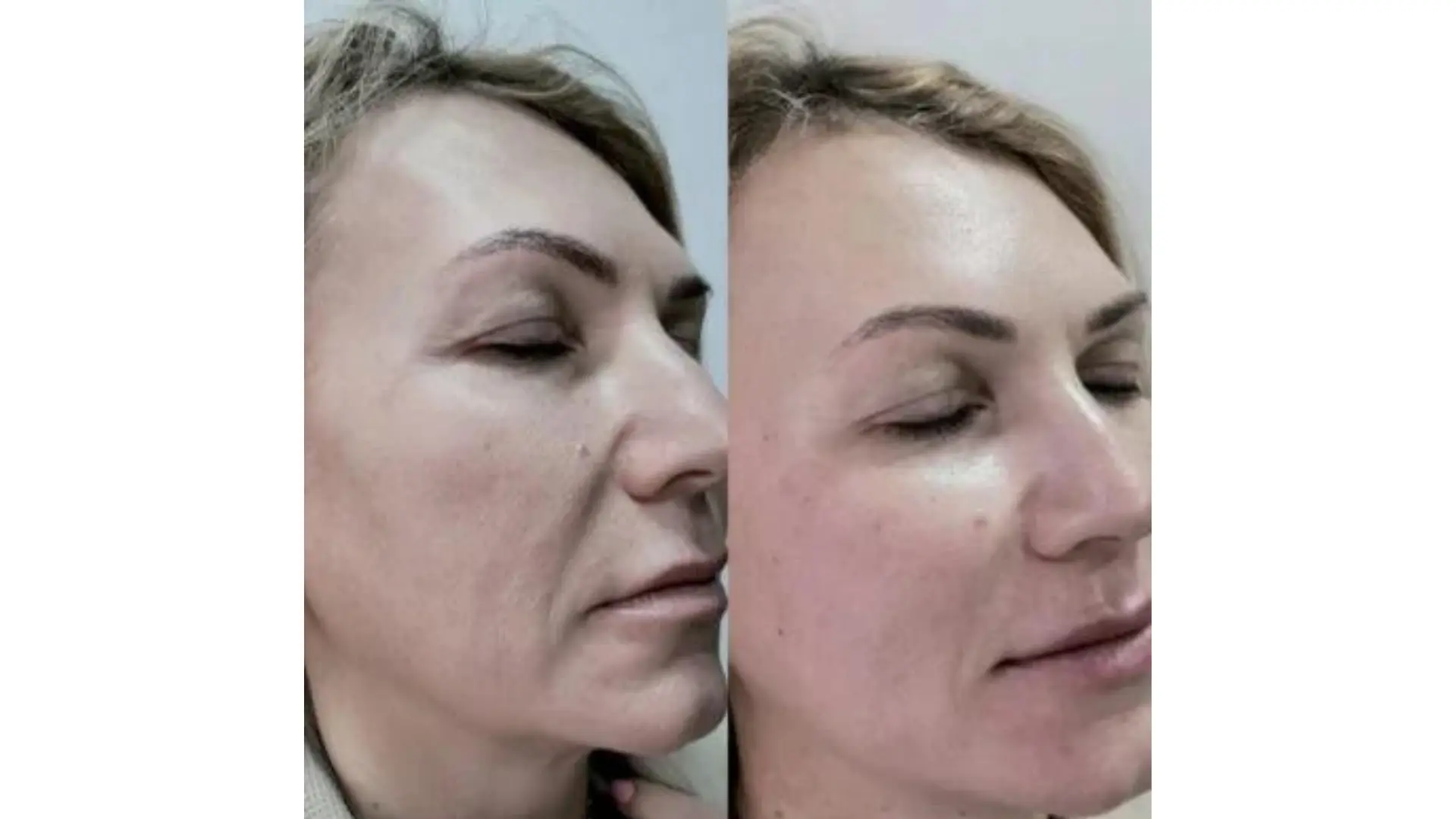 Ảnh trước sau jalupro: lưu ý khi xem và đánh giá