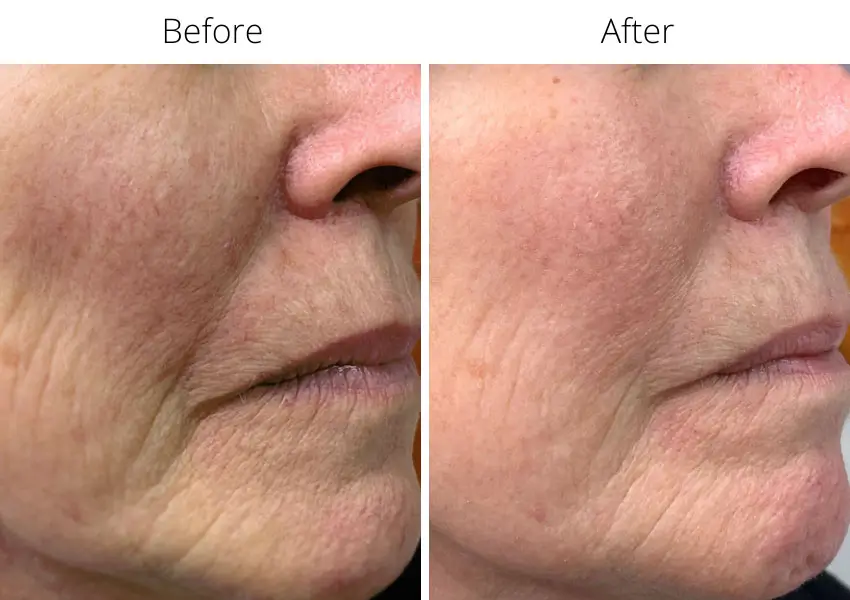 3. Phác đồ điều trị lâm sàng jalupro thường như thế nào