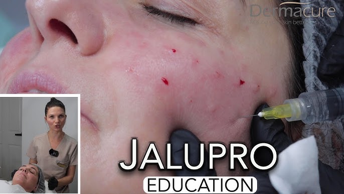 Ưu nhược điểm khi chọn jalupro hay Profhilo