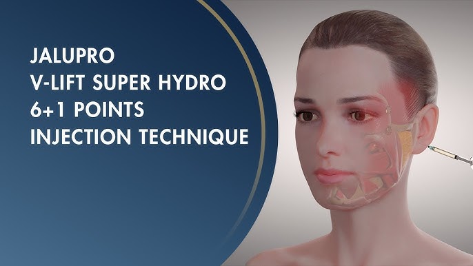 4. Jalupro bap có phải là kỹ thuật chính thức