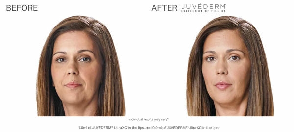 Lưu ý khi xem ảnh trước sau juvederm