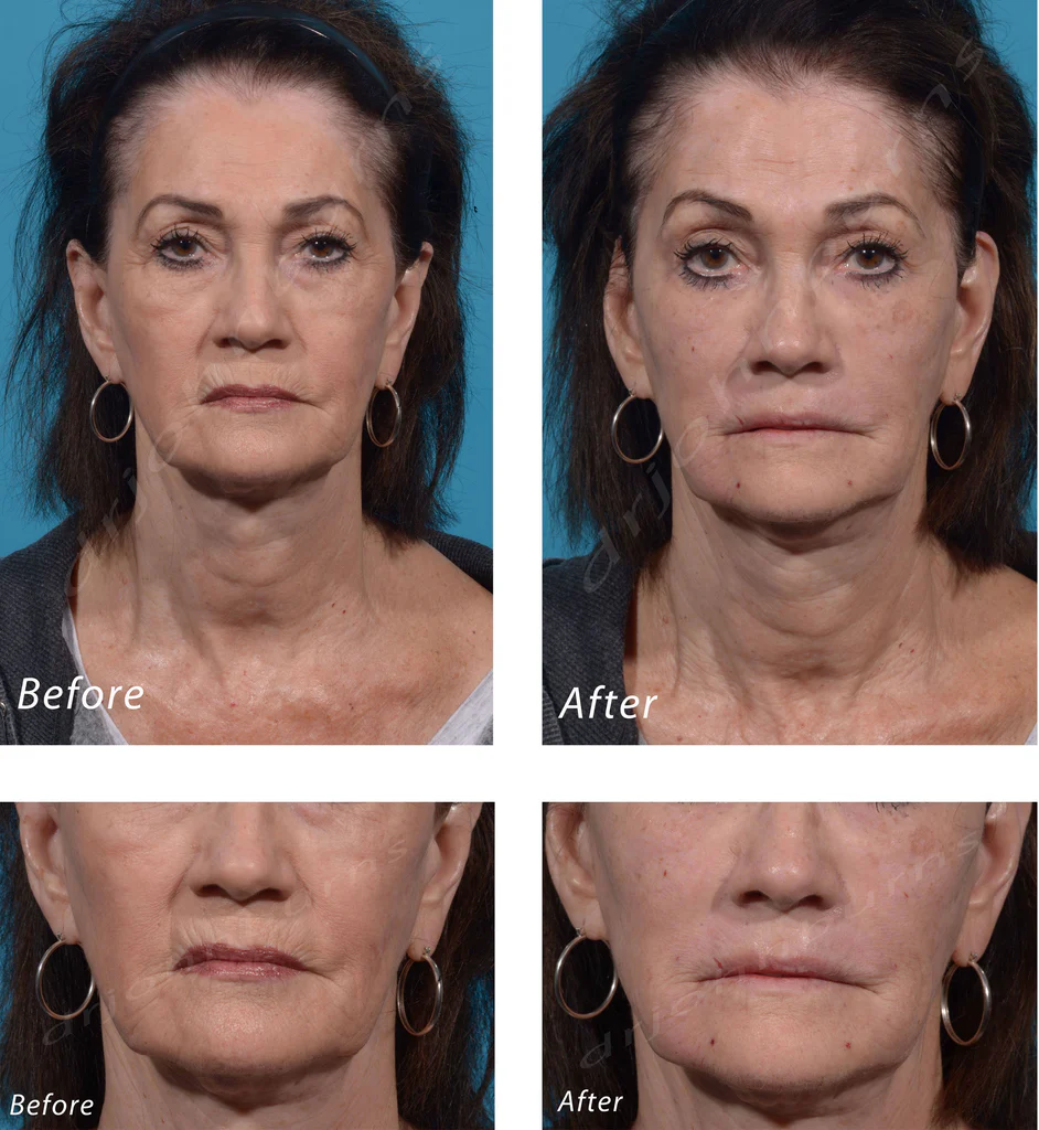 Yếu tố giúp bạn có juvederm before and after như mong muốn