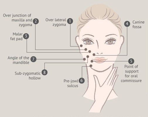 Juvederm injection points cho môi