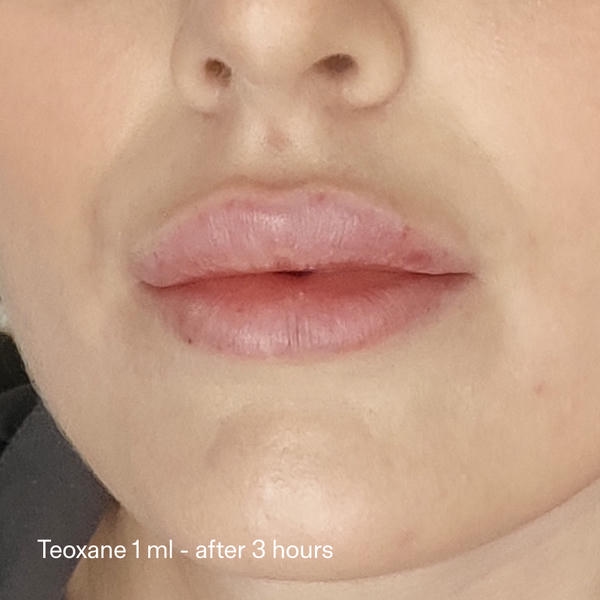 2. Redensity 2 khác gì so với Juvederm Volbella