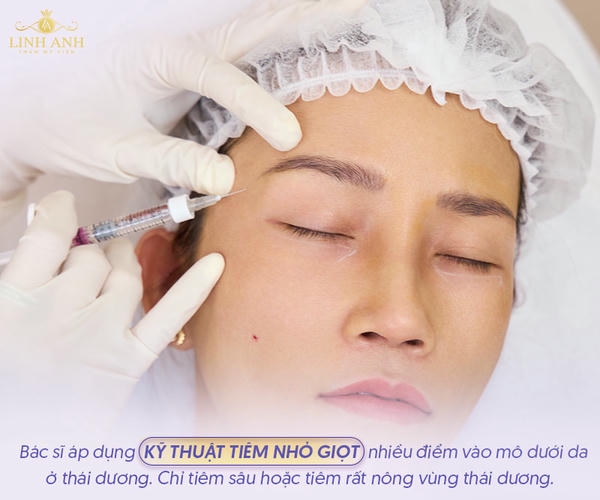 1. Cannula filler có giảm đau hơn không