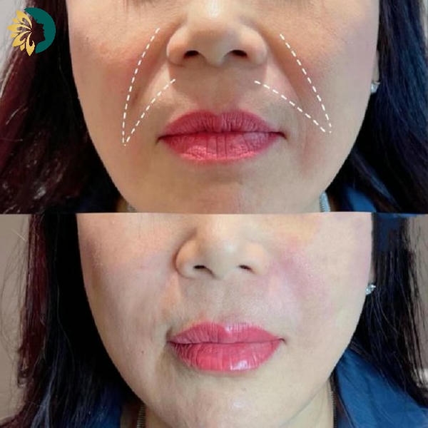 So sánh cơ bản: cannula filler và kim filler