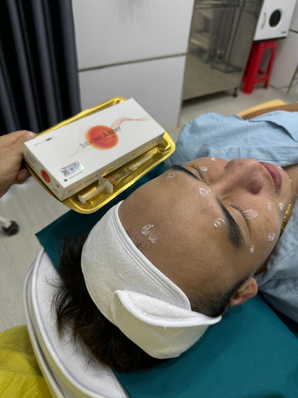Microneedling amber: Khi nào chọn kỹ thuật này