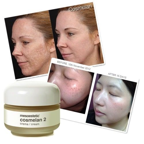 Trị nám bao lâu mới cần làm lại