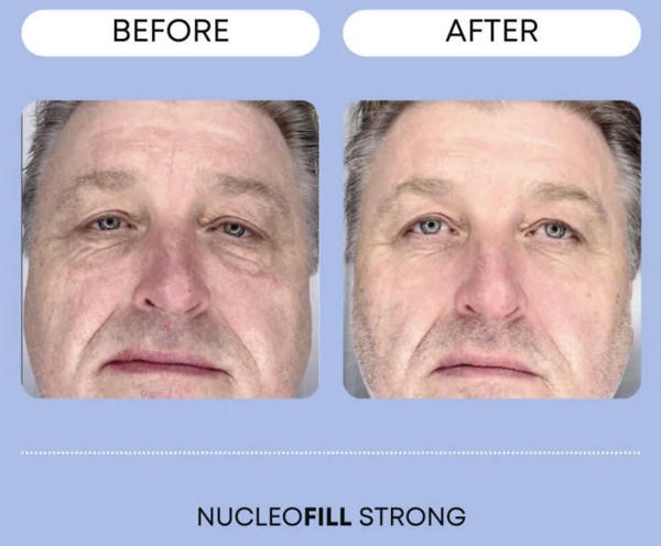 Kết hợp liệu trình nucleofill với phương pháp khác