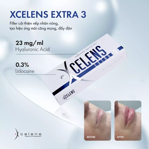 Filler bao lâu thì cần tiêm lại