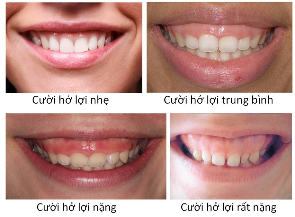Quy trình tiêm nabota cười hở lợi an toàn
