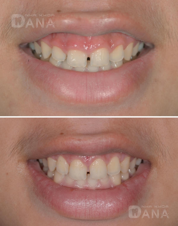 Rủi ro, tác dụng phụ và cách quản lý