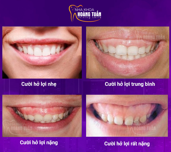 Botox lợi và cách phân biệt với tiêm mô mềm khác