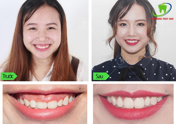 3. Có cần nghỉ làm sau khi tiêm nabota cười hở lợi không