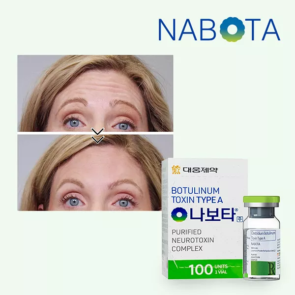 3. Tôi đã dùng Botox, có thể đổi sang Nabota hoặc Dysport được không?