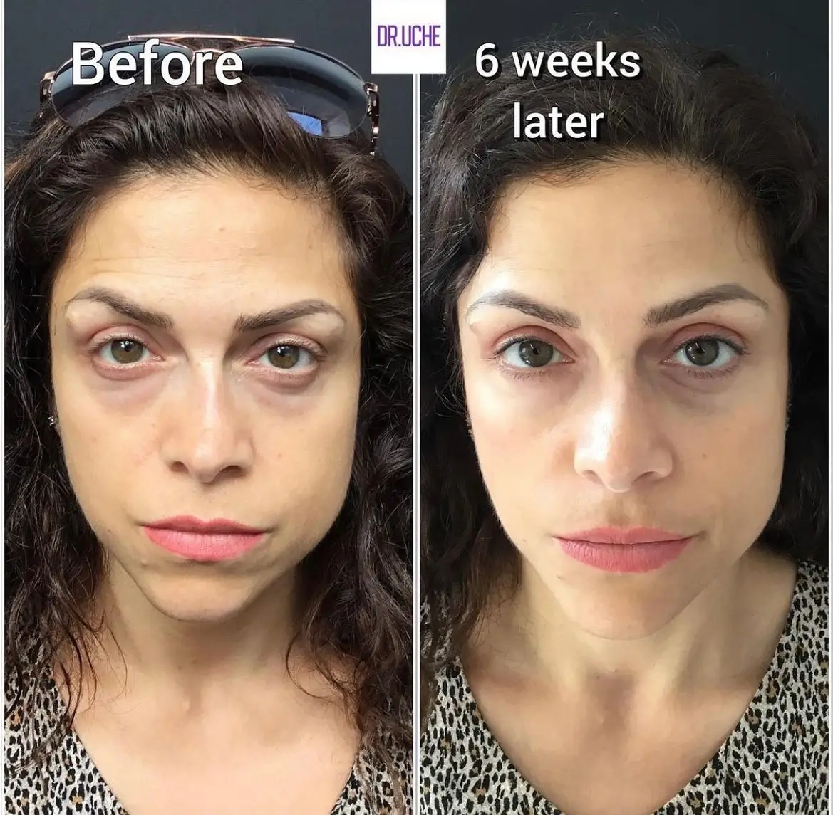 bap injection: Kỹ thuật và ý nghĩa trong liệu pháp Profhilo