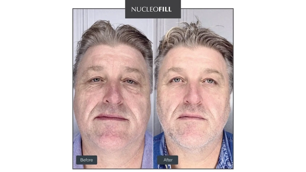 Bảng so sánh nhanh: nucleofill vs profhilo