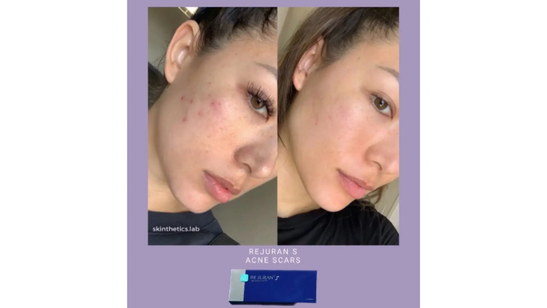 Khi nào chọn nucleofill và khi nào chọn rejuran — so sánh pn theo nhu cầu