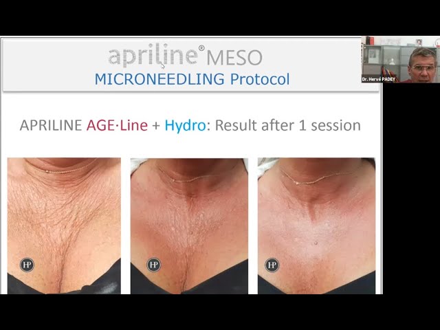 Rãnh lệ và vùng dưới mắt